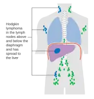 Stage 4 Hodgkin lymphoma