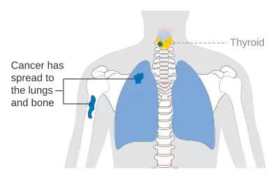 Stage M1 thyroid cancer