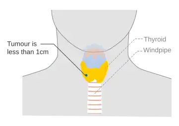 Stage T1a thyroid cancer