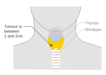 Stage T1b thyroid cancer