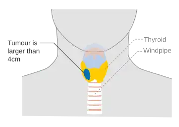 Stage T3 thyroid cancer