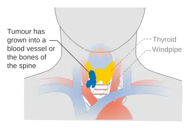 Stage T4b thyroid cancer