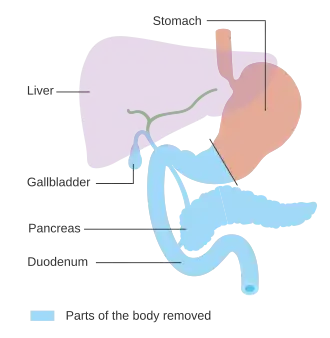Diagram of the alimentary tract highlighting the gallbladder, pancreas, duodenum and distal stomach