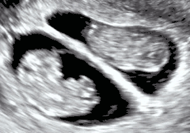 Dichorionic–diamniotic twins at eight weeks and five days since co-incubation as part of IVF. The twin at left in the image is shown in the sagittal plane with the head pointing towards upper left. The twin at right in the image is shown in the coronal plane with the head pointing rightwards.