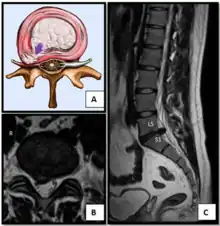 Nucleus herniating through tear in annulus (with MRI)[8]