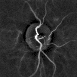 Laser Doppler imaging of the papilla of a patient with hypertension]]