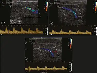 Longitudinal, ventral ultrasound of the penis, with pulsed mode and color Doppler. Flow of the cavernous arteries at 5, 15, and 25 min after prostaglandin injection (A, B, and C, respectively). The cavernous artery flow remains below the expected levels (at least 25–35&nbsp;cm/s), which indicates ED due to arterial insufficiency.[39]