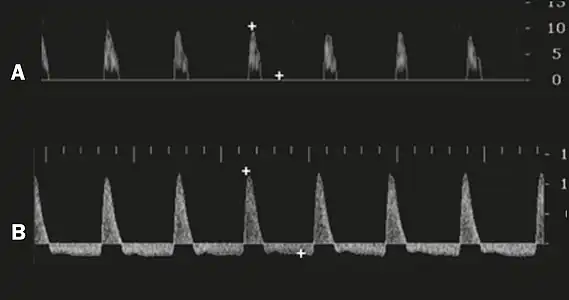 Graphs representing the color Doppler spectrum of the flow pattern of the cavernous arteries during the erection phases. A: Single-phase flow with minimal or absent diastole when the penis is flaccid. B: Increased systolic flow and reverse diastole 25 min after injection of prostaglandin.[39]