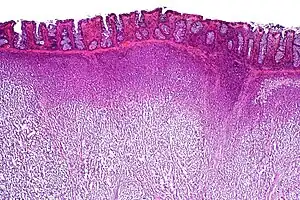 Low-power view of a dysgerminoma infiltrating the colonic wall, H&E stain.