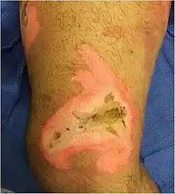 An image of a skin burn to the medial right thigh above the knee of a 35-year-old male.