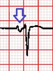 ECG of V1 showing the large negative of the P wave indicating left atrial enlargement[7]