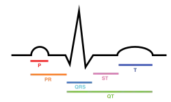 Normal ECG tracing for a single contraction of the heart.