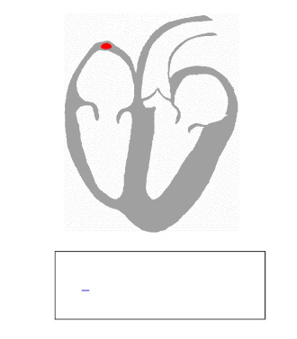 ECG tracing in relation to normal depolarization and contraction of the heart. Red tracing indicates pathway of electrical depolarization. Blue tracing indicates resulting ECG tracing.