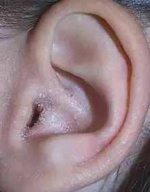 Auricular eczema