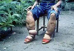 Elephantiasis of the legs due to filariasis. Luzon, Philippines.
