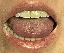 Elevated tongue due to Ludwig's angina