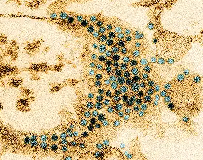 Transmission electron micrograph of enterovirus D68 virus particles[17]
