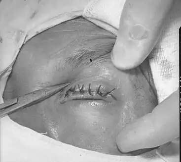 Surgical repair of in-turned eyelid and eyelashes resulting from trachoma