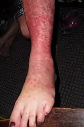 Erythema multiforme target lesions on the leg
