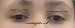 Strabismus from ONH