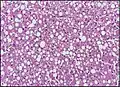 Micrograph of fatty liver showing lipid steatosis. H&E stain.