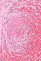Micrograph showing a thrombus (center of image) within a blood vessel of the placenta. H&E stain.
