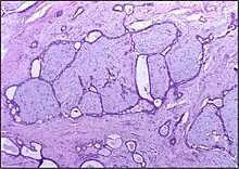 Histopathologic image of breast fibroadenoma showing proliferation of intralobular stroma compressing and distorting the epithelium. H&E stain.