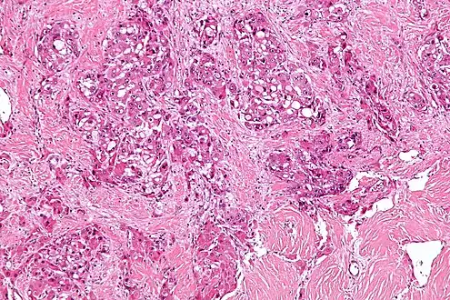 Intermed. mag.Fibrolamellar hepatocellular carcinoma