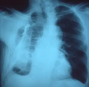 Chest x-ray showing fibrous opacity on one side