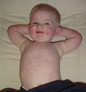 Child showing signs of erythema infectiosum, also known as fifth disease