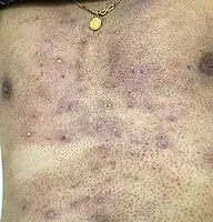 Folliculitis post shaving