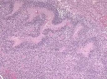 Pseudopalisading seen around necrosis in glioblastoma