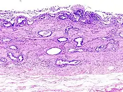 Incidentally discovered gallbladder cancer (adenocarcinoma) following a cholecystectomy.