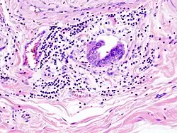 Gallbladder adenocarcinoma lymphatic invasion histopathology