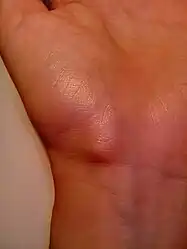 Ganglion cyst on the palmar side of the left wrist
