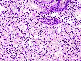 Gastric signet ring cell carcinoma. H&E stain.