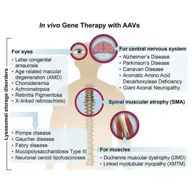 Gene therapy (in vivo ) with AAV[73]