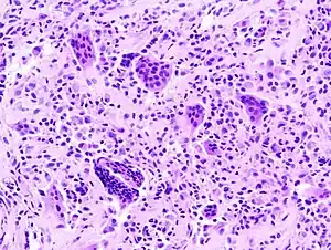 Histopathology of localized TGCT arising in hand finger. H&E stain.