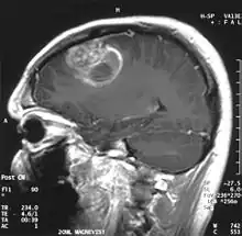Sagittal MRI with contrast of a glioblastoma WHO grade IV in a 15-year-old