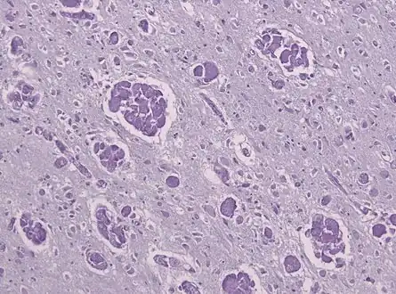 A histopathology slide of a brain with Krabbe disease showing giant cells with PAS stain inclusions ("globoid cells") within astrocytic gliosis and loss of myelinated fibers.