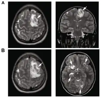 A: T2-weighted MRI showing liquefied, necrotic brain tissue as a result of GAE caused by Balamuthia mandrillaris B: T1-weighted MRI showing expansion and addition of necrotic areas 4 days later