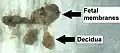 Gross pathology of fetal membranes versus decidua