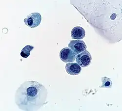 High-grade urothelial carcinoma. A cytologic diagnosis of high-grade urothelial carcinoma requires > 10 cells with high N/C ratio, irregular chromatin pattern and hyperchromatic nuclei (Pap stain).