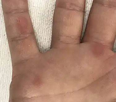 Close up of the lesions