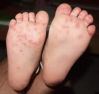 Hand foot and mouth disease on childs feet