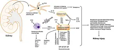 Mechanism of Hantavirus induced AKI[13]