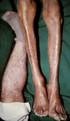 Legs of a 62 year old white person with darkening skin due to iron overload. The leg to the left is a normal individual.[9]