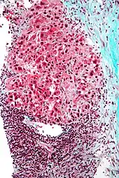Micrograph of hepatocellular carcinoma. Liver biopsy.