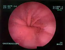 Upper GI endoscopy depicting hiatal hernia