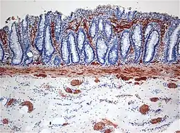 Histopathology of Hirschsprung disease showing abnormal acetylcholine esterase (AchE)-positive nerve fibers (brown) in the mucosa